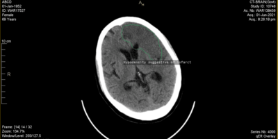 Delivering medical cloud AI on smartphones