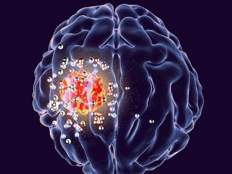 Wireless power implant could help remove brain tumours