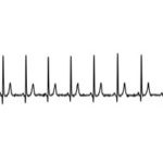 AI smart watches could predict higher risk of heart failure