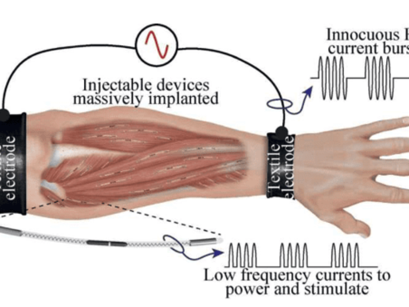 A human-machine interface to stop muscle tremors
