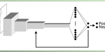 New AI model detects ninety percent of lymphatic cancer cases