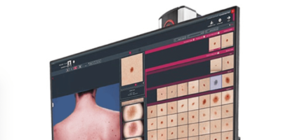 Fast, reliable Skin Cancer detection with AI